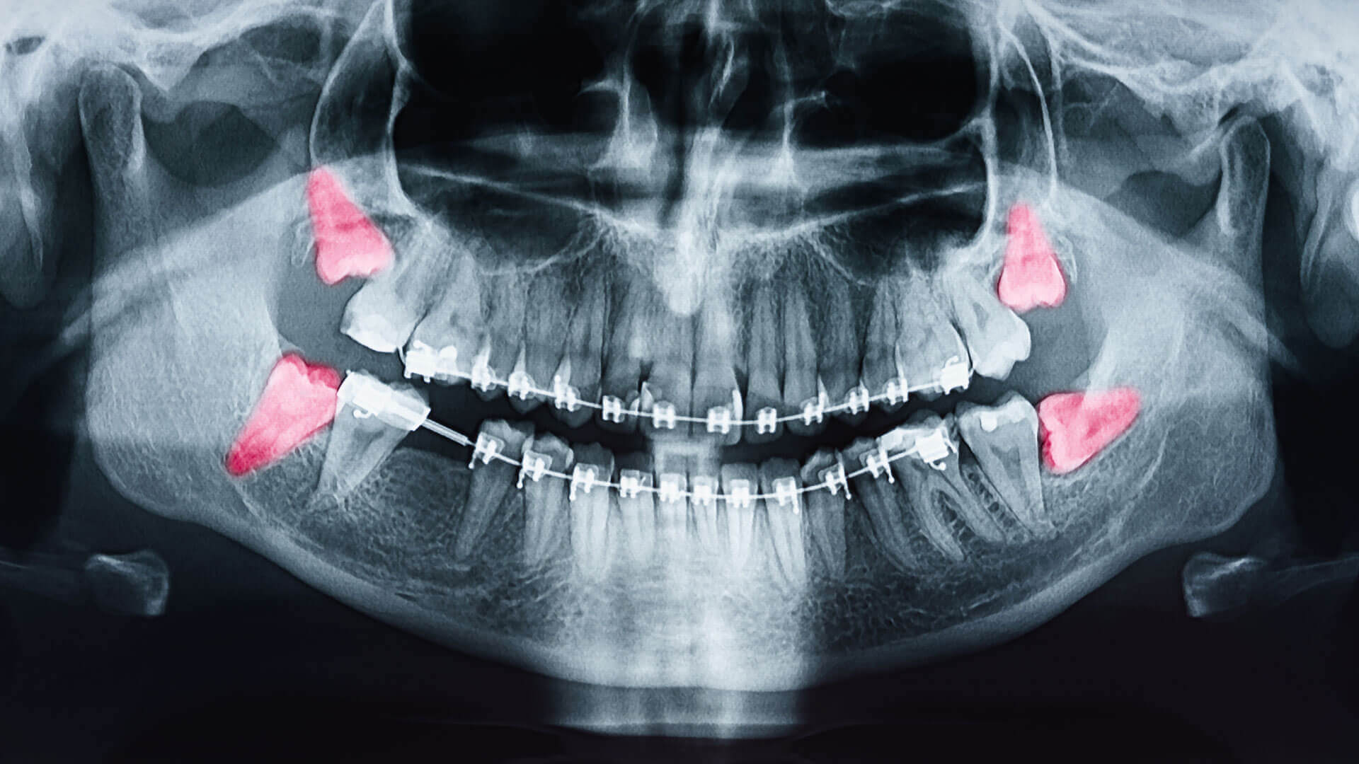 How to Know if Your Wisdom Teeth Need to be Removed