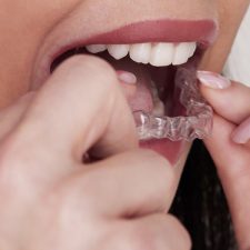 How Orthodontic Treatment Improves Oral Health and Facial Alignment